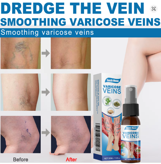 VaricoseVeins Spray™ (Para piernas cansadas y venas visibles)
